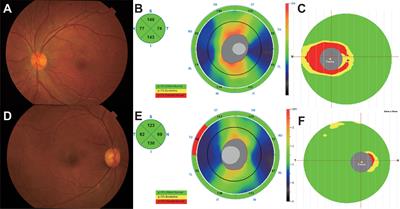 Corrigendum: Different immunological mechanisms between AQP4 antibody-positive and MOG antibody-positive optic neuritis based on RNA sequencing analysis of whole blood